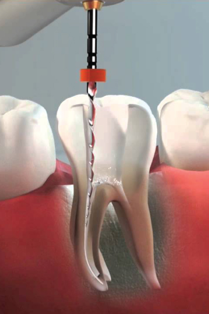 Dolor de muela Panama Endodoncia Asistente en Smile Center clinica odontologia Panama Odontología Avanzada Ortodoncia Endodoncia Implantes Periodoncia Rehabilitacion Oral Muelas del Juicio